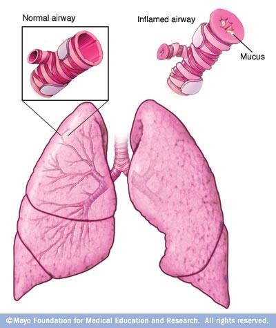 Asthma Management Asthma Management